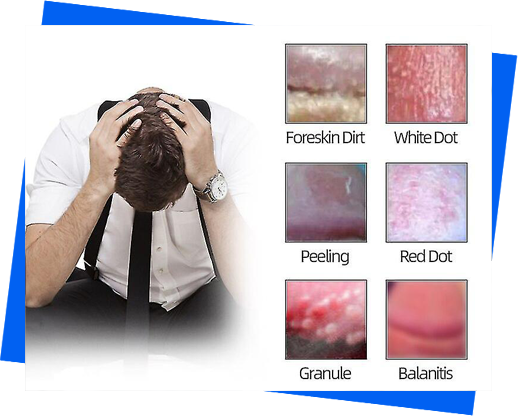 balanitis-treatment-in-noida