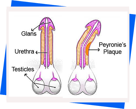 dyspareunia-in-male