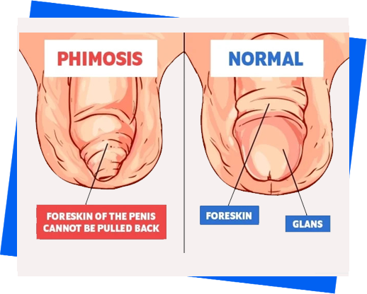 phimosis-paraphimosis-treatment-in-noida