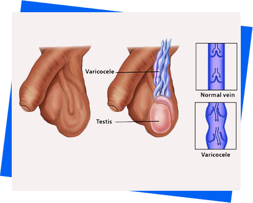 varicocele